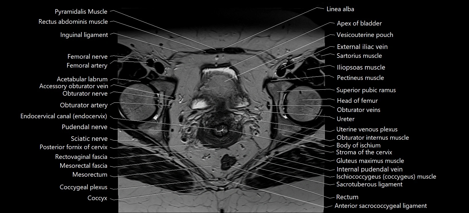 Axial cross sectional anatomy of female pelvis (MRI 3T) image 26.webp